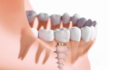 имплантация